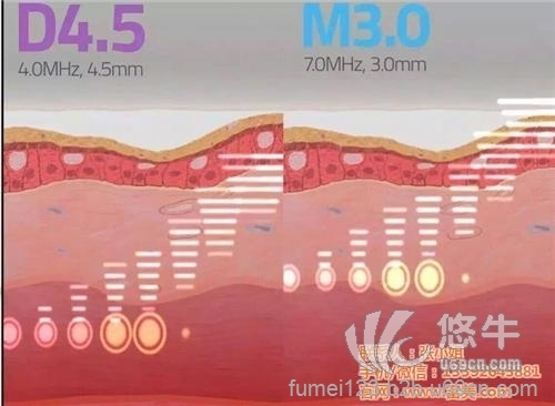 韩国私密超声刀配件销售图1