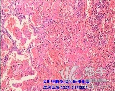 病理切片大叶性肺炎图1